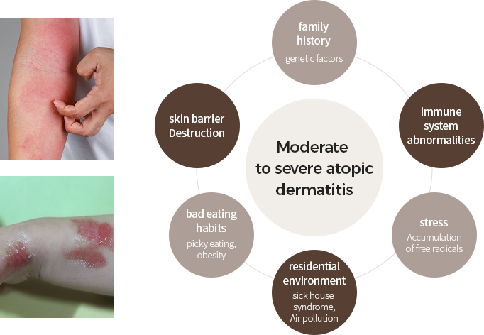 중등증-중증 아토피 피부염